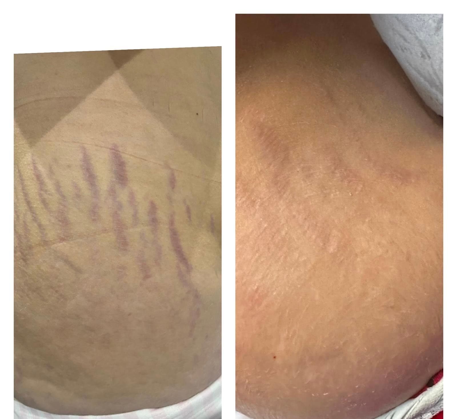 Anti-wrinkle treatment before and after results