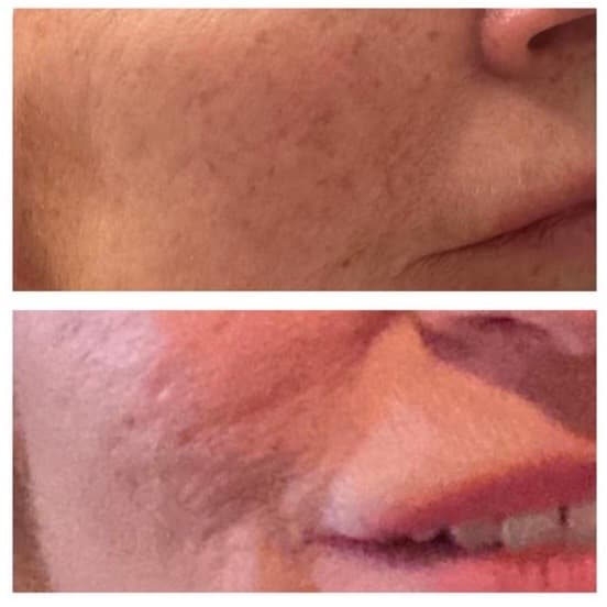 Skin rejuvenation treatment results