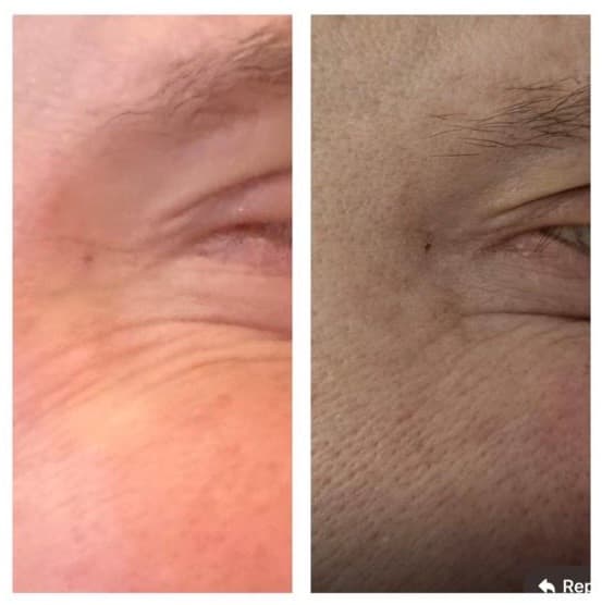 Facial treatment before and after results