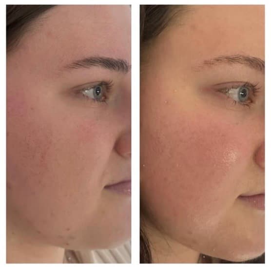 Skin booster treatment results