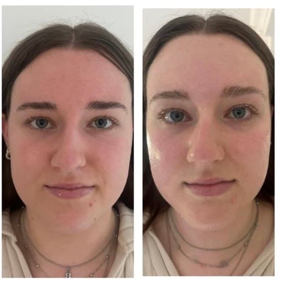 Microneedling treatment before and after results